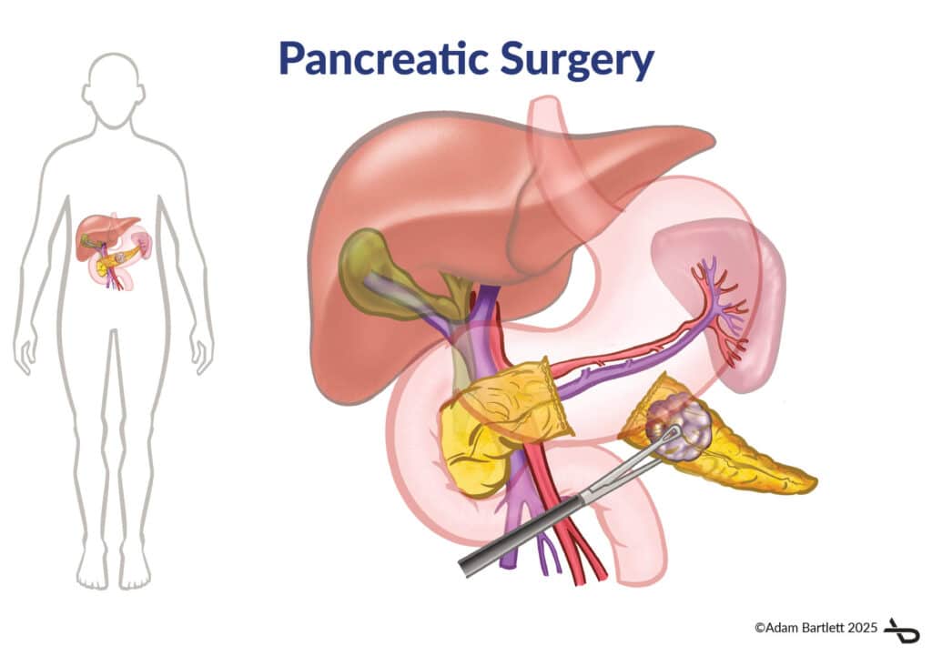 Adam_Bartlett-Pancreatic_Surgery Pancreatic Surgery