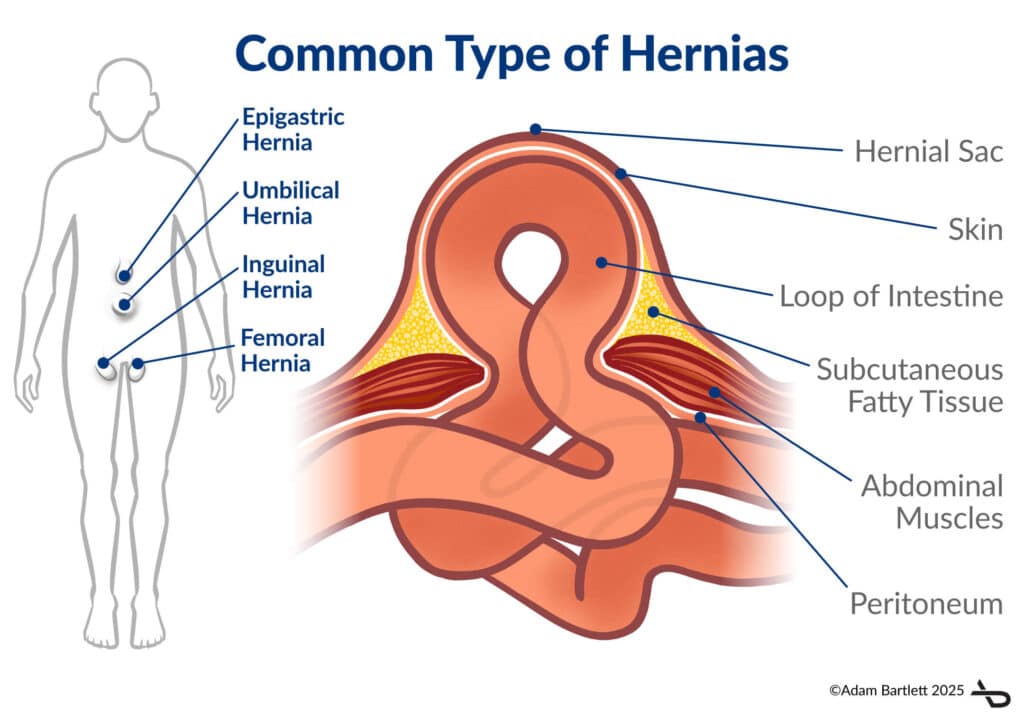 Common types of Hernia