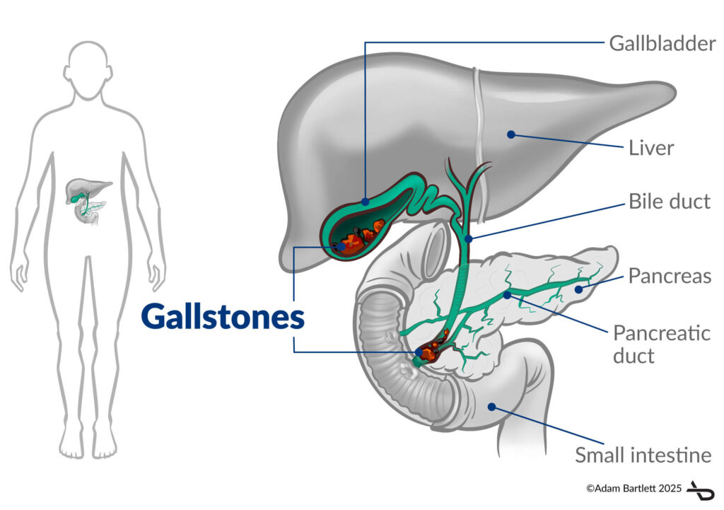 Gallstones in the Gallbladder