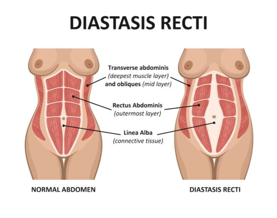 Diastasis recti. Abdominal muscle diastasis after pregnancy pregnancy and childbirth.