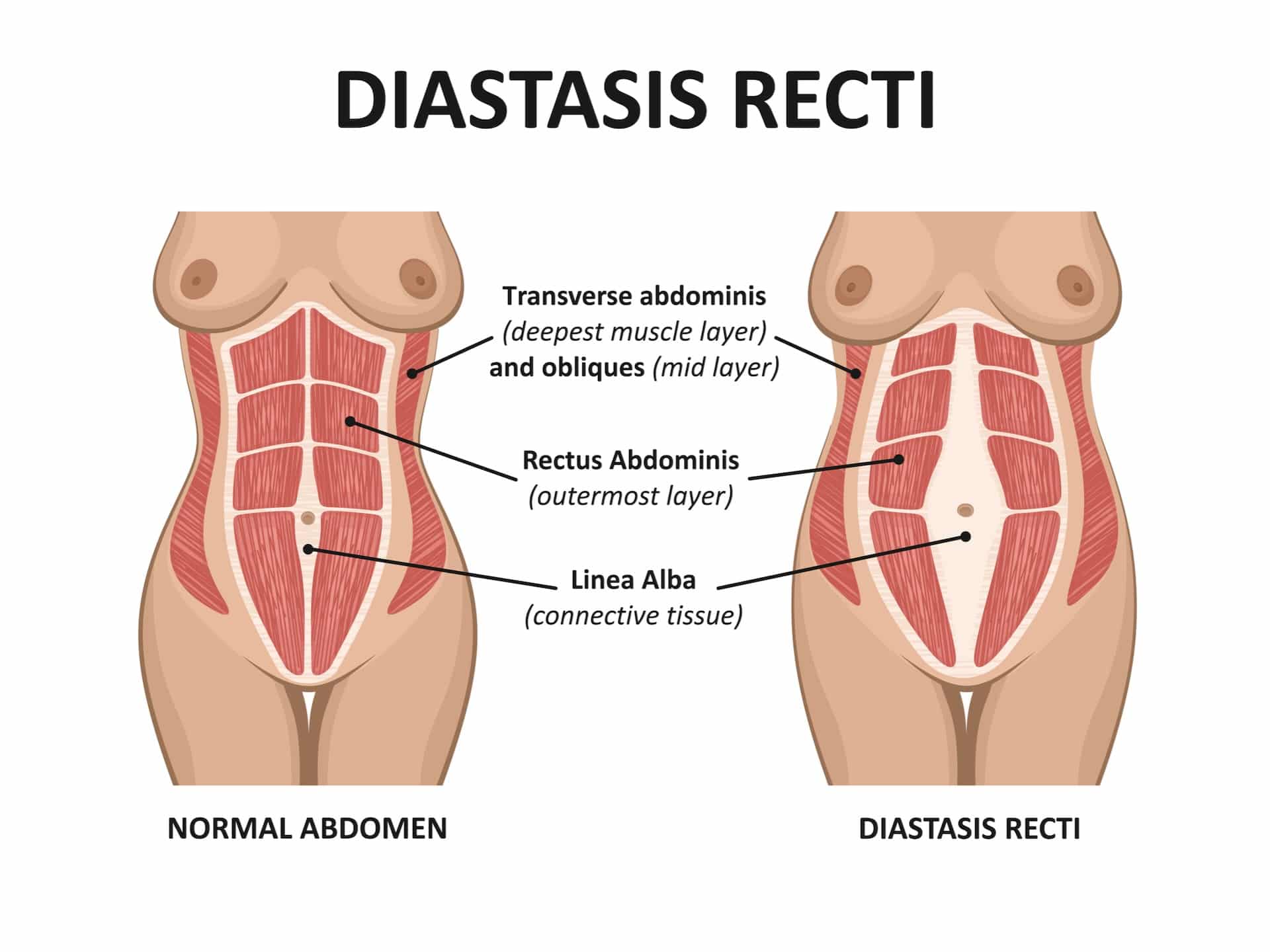 Diastasis recti. Abdominal muscle diastasis after pregnancy pregnancy and childbirth. Diastasis recti. Abdominal muscle diastasis after pregnancy pregnancy and childbirth.