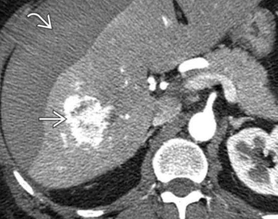 Hepatic Adenoma